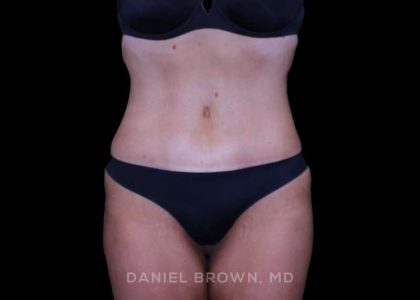 Tummy Tuck Before & After Patient #11094