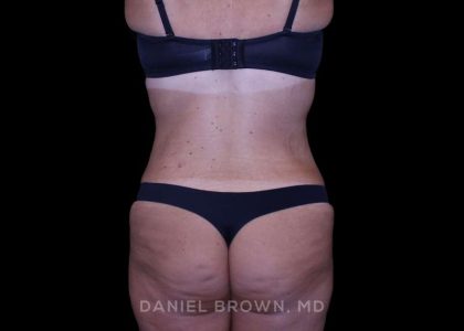 Tummy Tuck Before & After Patient #11094