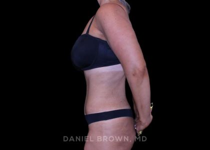 Tummy Tuck Before & After Patient #11094