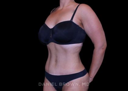 Tummy Tuck Before & After Patient #11094