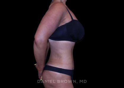 Tummy Tuck Before & After Patient #11094