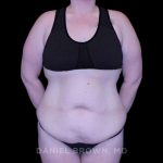 Tummy Tuck Before & After Patient #11094