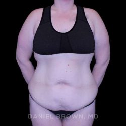 Tummy Tuck Before & After Patient #11094