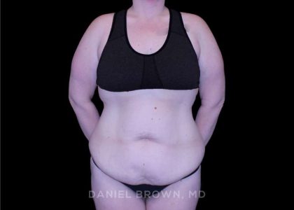 Tummy Tuck Before & After Patient #11094