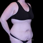 Tummy Tuck Before & After Patient #11094