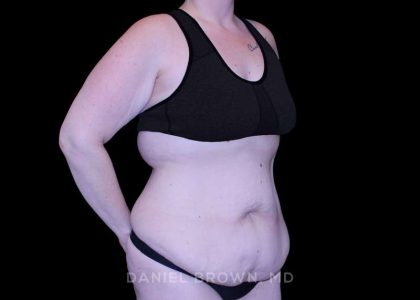 Tummy Tuck Before & After Patient #11094