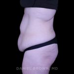 Tummy Tuck Before & After Patient #11094