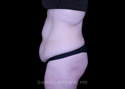 Tummy Tuck Before & After Patient #11094