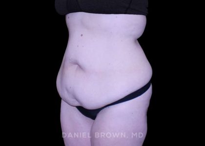 Tummy Tuck Before & After Patient #11094