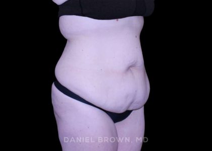 Tummy Tuck Before & After Patient #11094