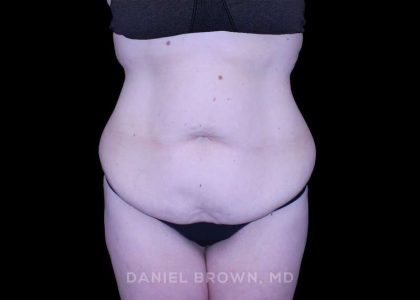 Tummy Tuck Before & After Patient #11094