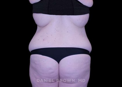 Tummy Tuck Before & After Patient #11094