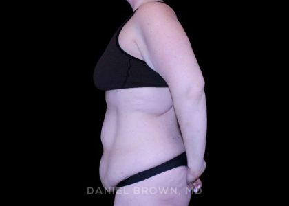 Tummy Tuck Before & After Patient #11094