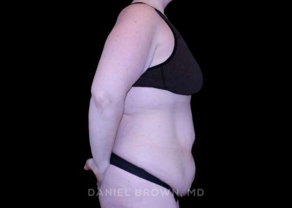 Tummy Tuck Before & After Patient #11094