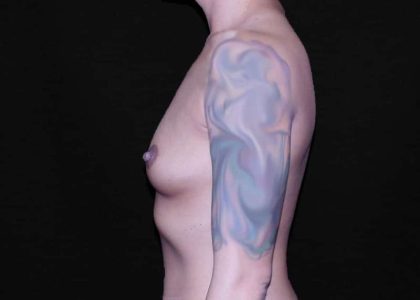 Breast Augmentation Before & After Patient #9493