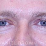 Blepharoplasty Before & After Patient #8667