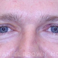 Blepharoplasty Before & After Patient #8667