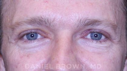 Blepharoplasty Before & After Patient #8667