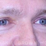 Blepharoplasty Before & After Patient #8667