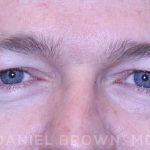 Blepharoplasty Before & After Patient #8667