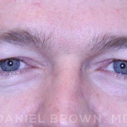 Blepharoplasty Before & After Patient #8667