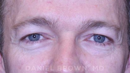 Blepharoplasty Before & After Patient #8667