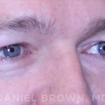 Blepharoplasty Before & After Patient #8667
