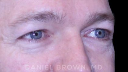 Blepharoplasty Before & After Patient #8667