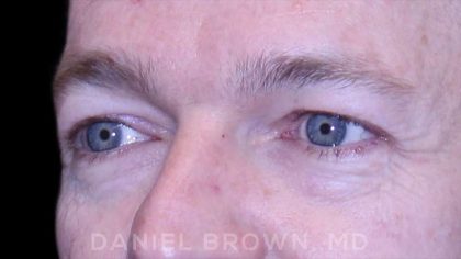 Blepharoplasty Before & After Patient #8667