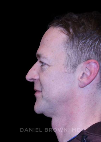 Blepharoplasty Before & After Patient #8667