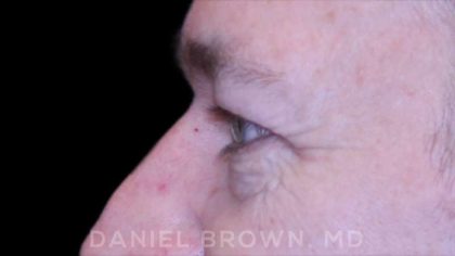 Blepharoplasty Before & After Patient #8667