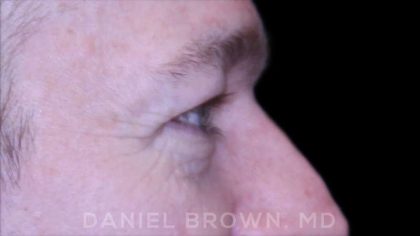 Blepharoplasty Before & After Patient #8667