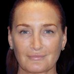 Blepharoplasty Before & After Patient #8688