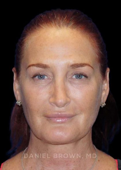 Blepharoplasty Before & After Patient #8688