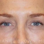 Blepharoplasty Before & After Patient #8688