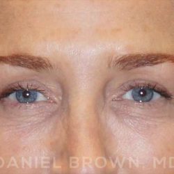 Blepharoplasty Before & After Patient #8688