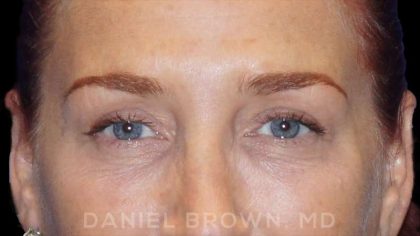 Blepharoplasty Before & After Patient #8688
