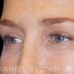 Blepharoplasty Before & After Patient #8688