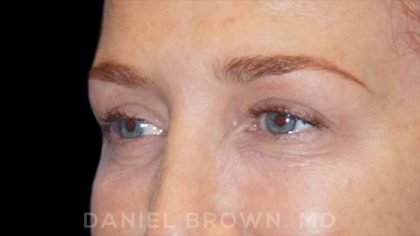 Blepharoplasty Before & After Patient #8688