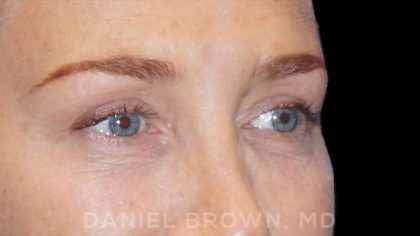 Blepharoplasty Before & After Patient #8688