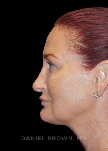 Blepharoplasty Before & After Patient #8688