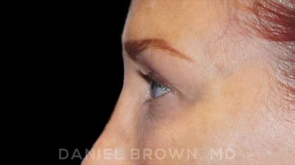 Blepharoplasty Before & After Patient #8688