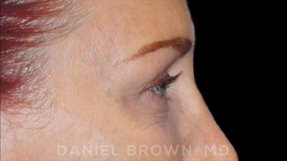 Blepharoplasty Before & After Patient #8688