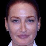 Blepharoplasty Before & After Patient #8688