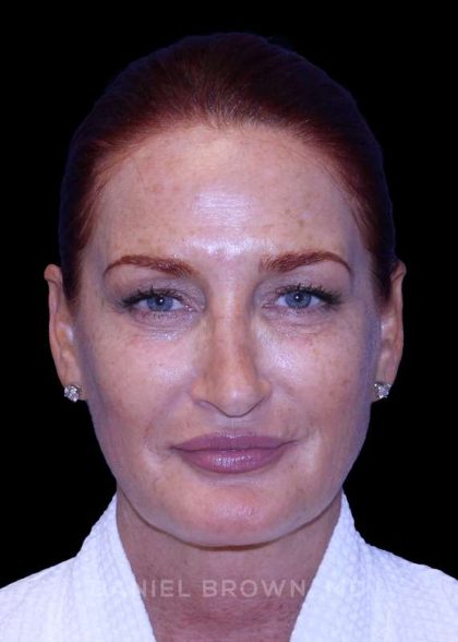 Blepharoplasty Before & After Patient #8688