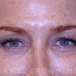 Blepharoplasty Before & After Patient #8688