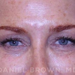Blepharoplasty Before & After Patient #8688