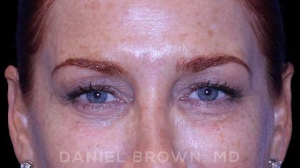 Blepharoplasty Before & After Patient #8688