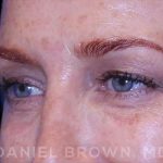 Blepharoplasty Before & After Patient #8688