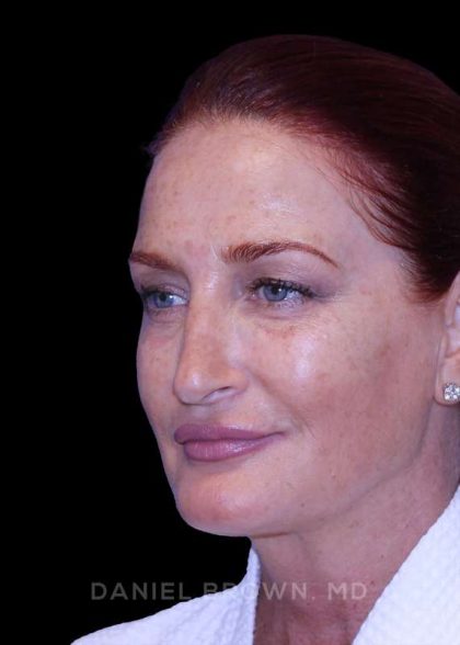 Blepharoplasty Before & After Patient #8688